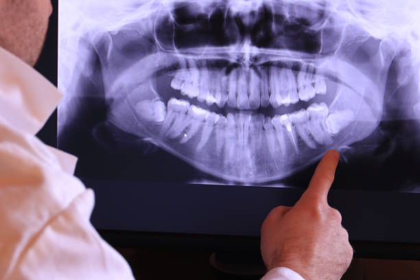 Best Emergency Wisdom Teeth Removal in Livingston, CA